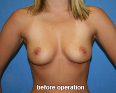 plastic-surgery-breast-augmentation